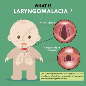 when does laryngomalacia resolve